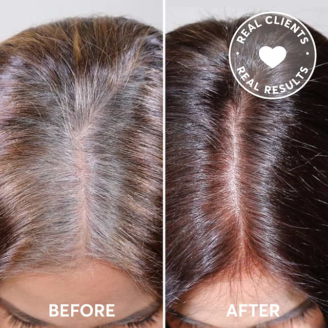 does melanotan darken hair II: Tanning injections, nasal sprays harmful to health EllieMD | Melanotan II Injection